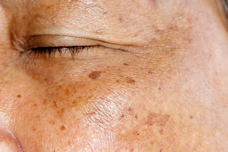 Hyperpigmentation/Melasma under Eye